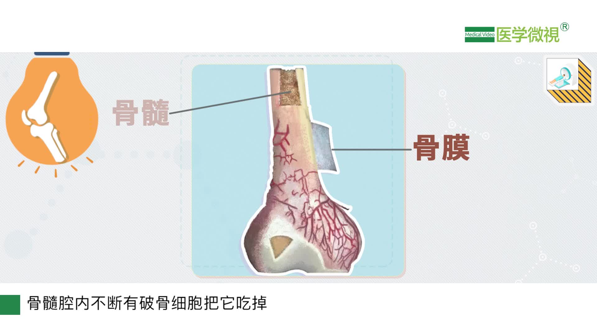 骨膜增生是怎么回事影像学表现上有什么特点