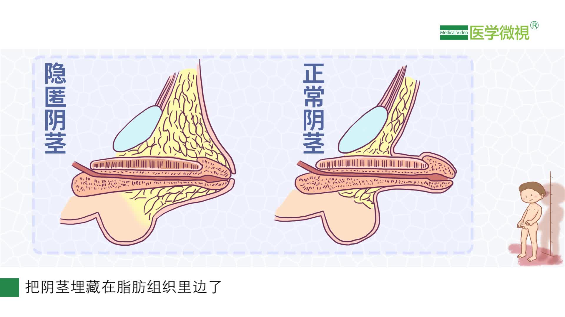 隐匿性阴茎是怎么回事