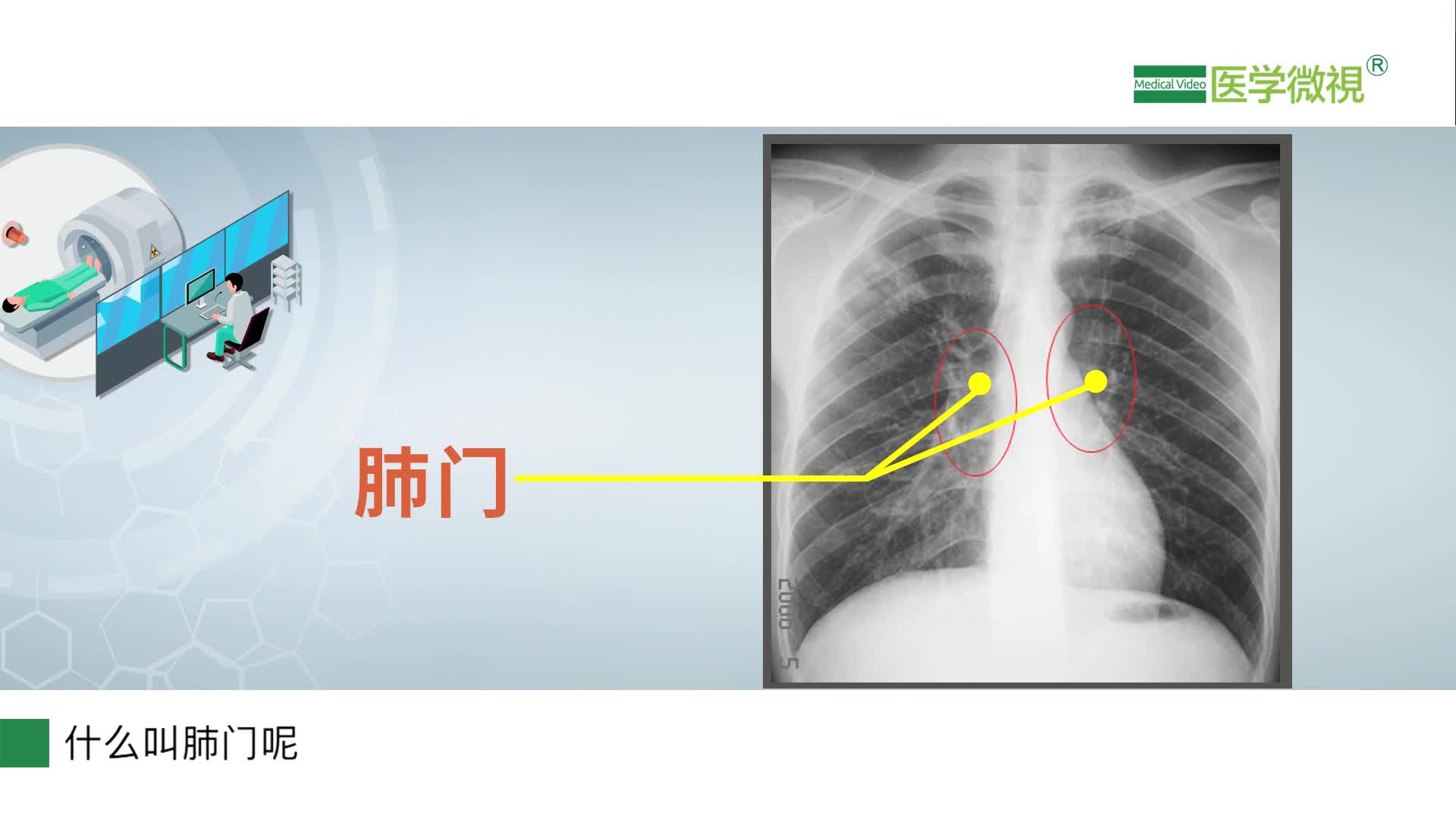 胸片检查报告提示肺门影浓密和肺门影增大是什么意思