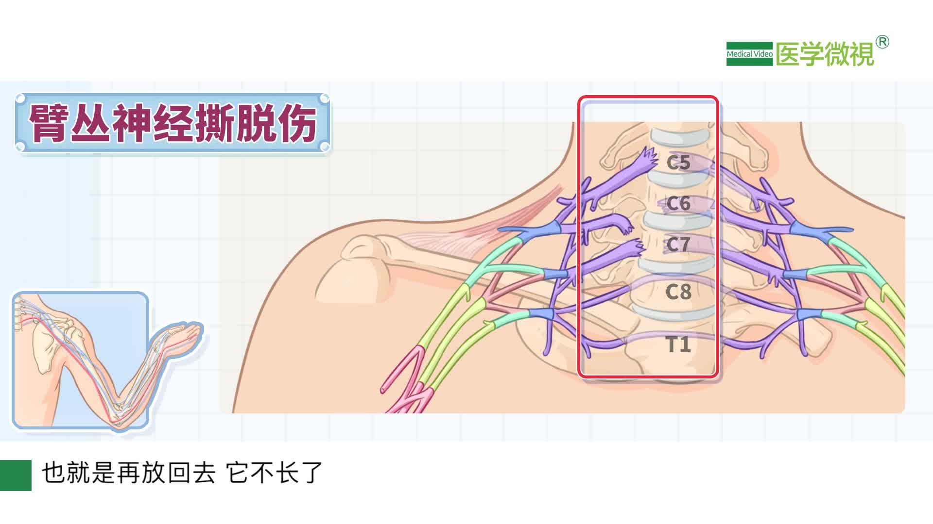 全臂丛神经撕脱伤是怎么回事 医学微视