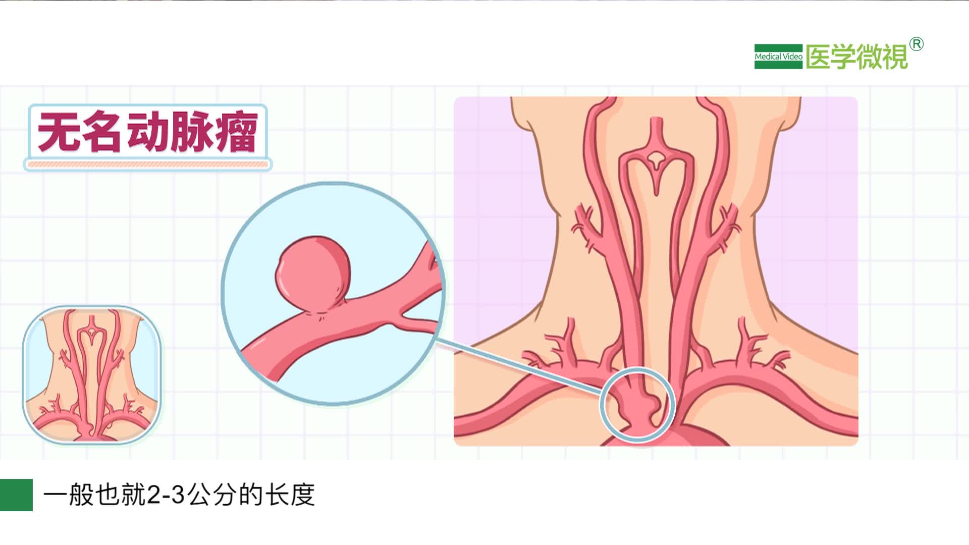 无名动脉瘤是怎么回事 该怎么治疗 样片1 医学微视