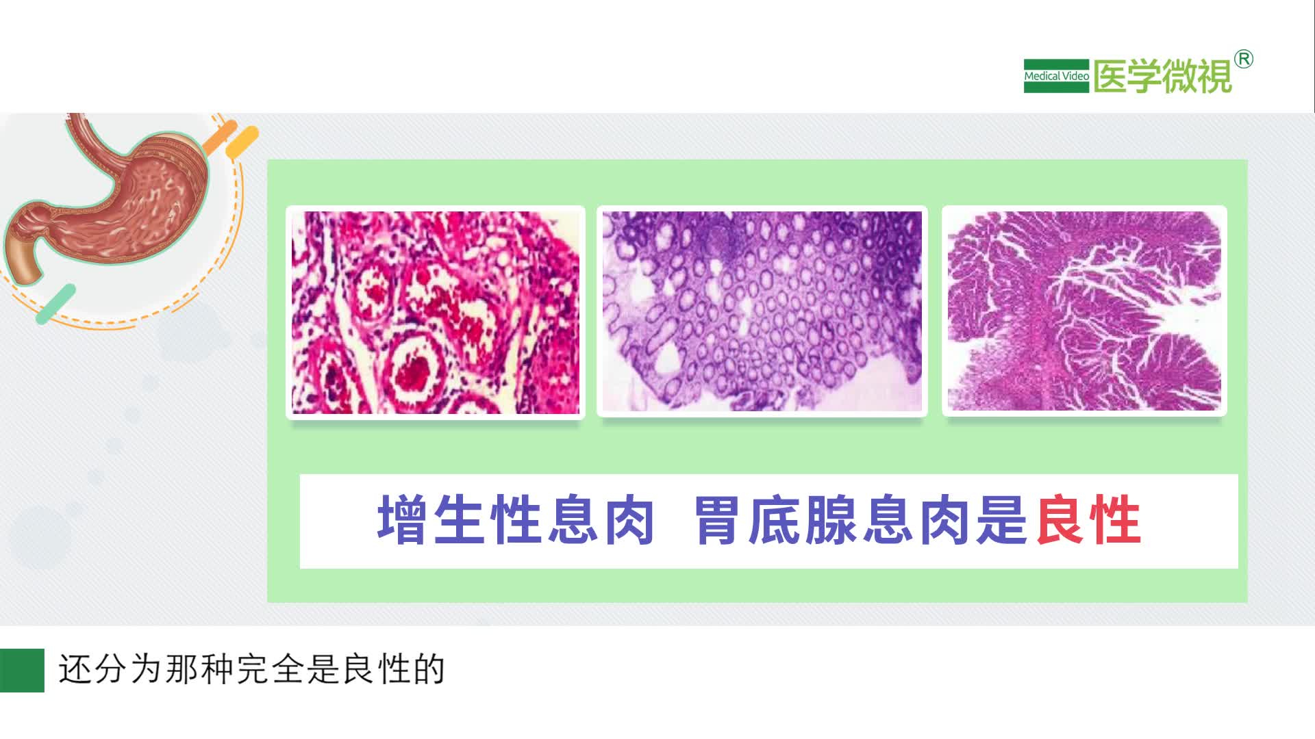 胃粘膜活檢病理報告單顯示增生性息肉胃底腺息肉腺瘤是良性病變嗎