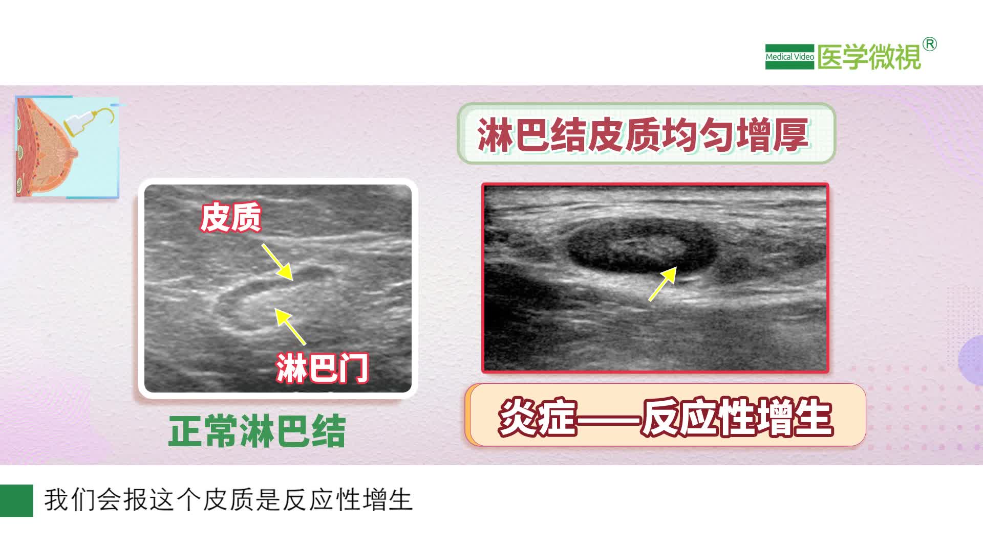 乳腺超聲描述腋窩淋巴結皮質增厚是什麼意思