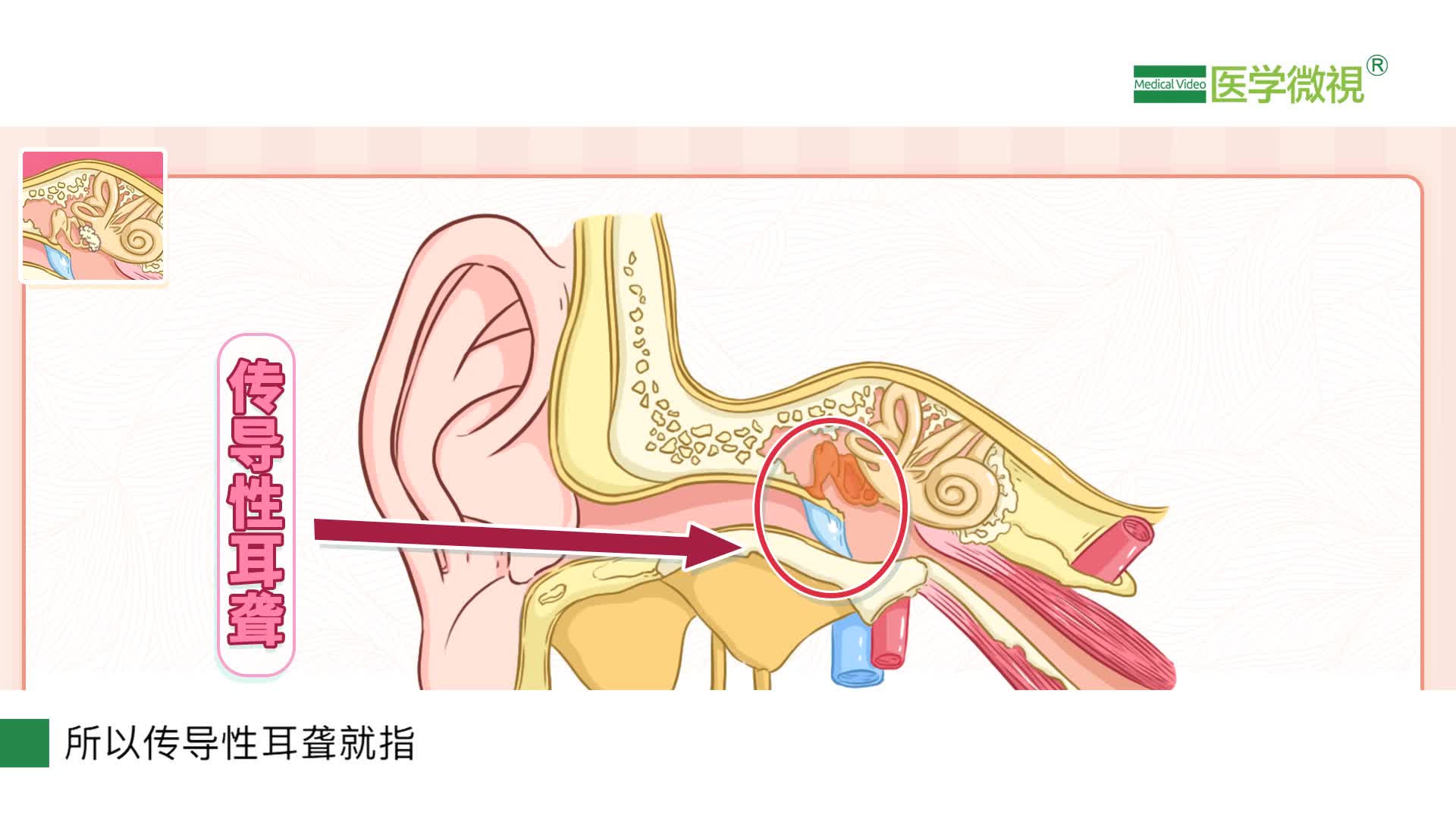 神经性耳聋和传导性耳聋有什么区别?