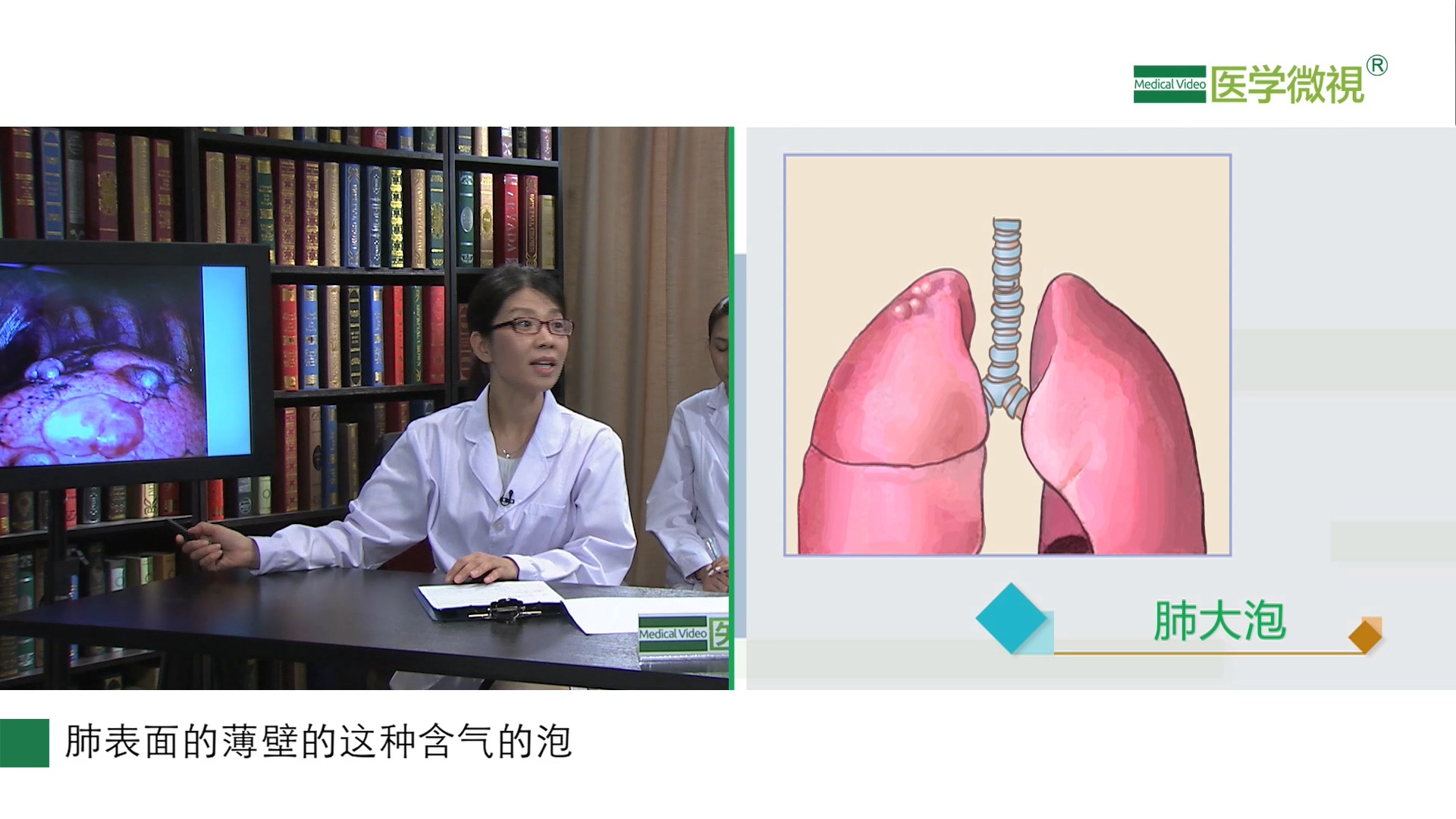 自发性气胸手术治疗的效果如何 医学微视