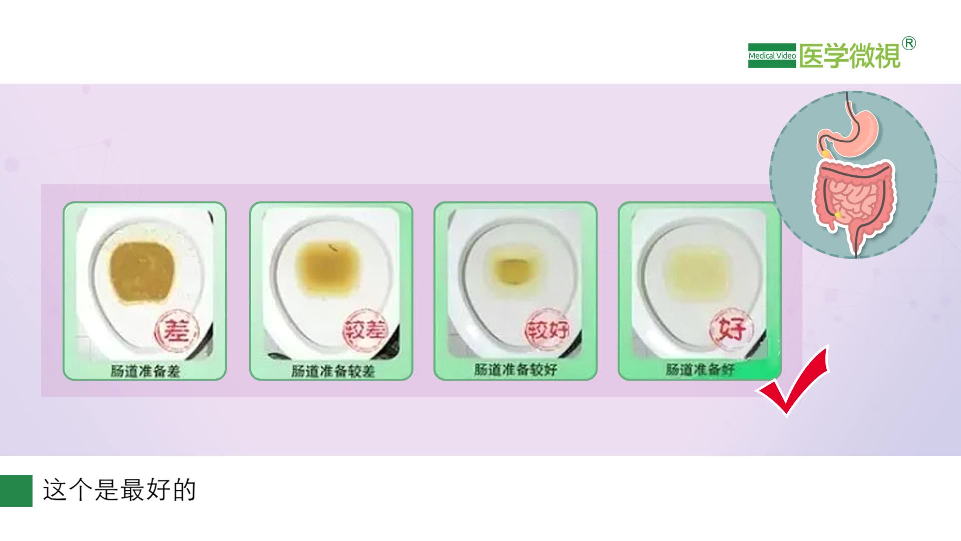 肠镜检查前排出什么样的大便才算清肠充分