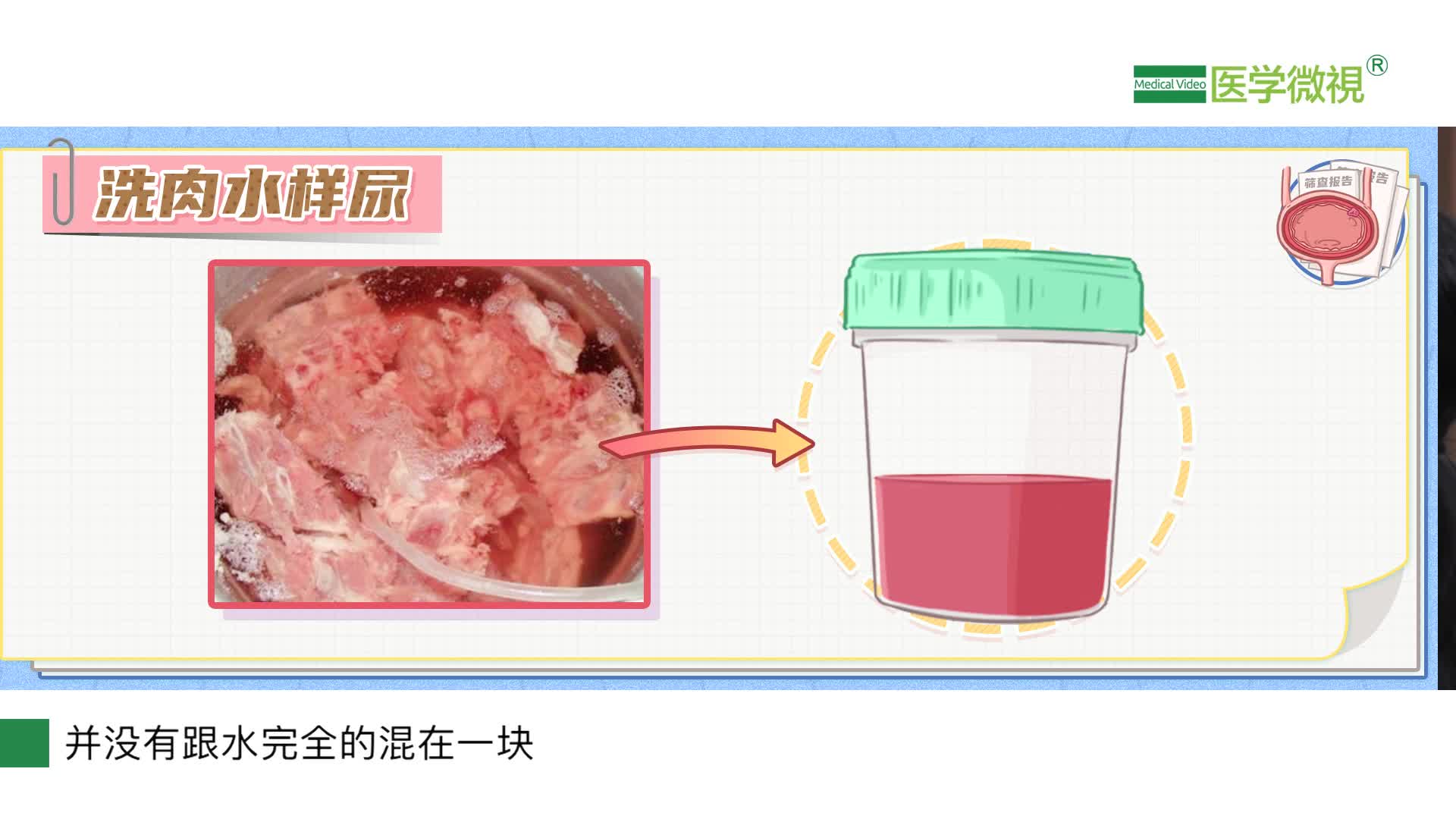 尿像洗肉水一樣會是膀胱癌嗎