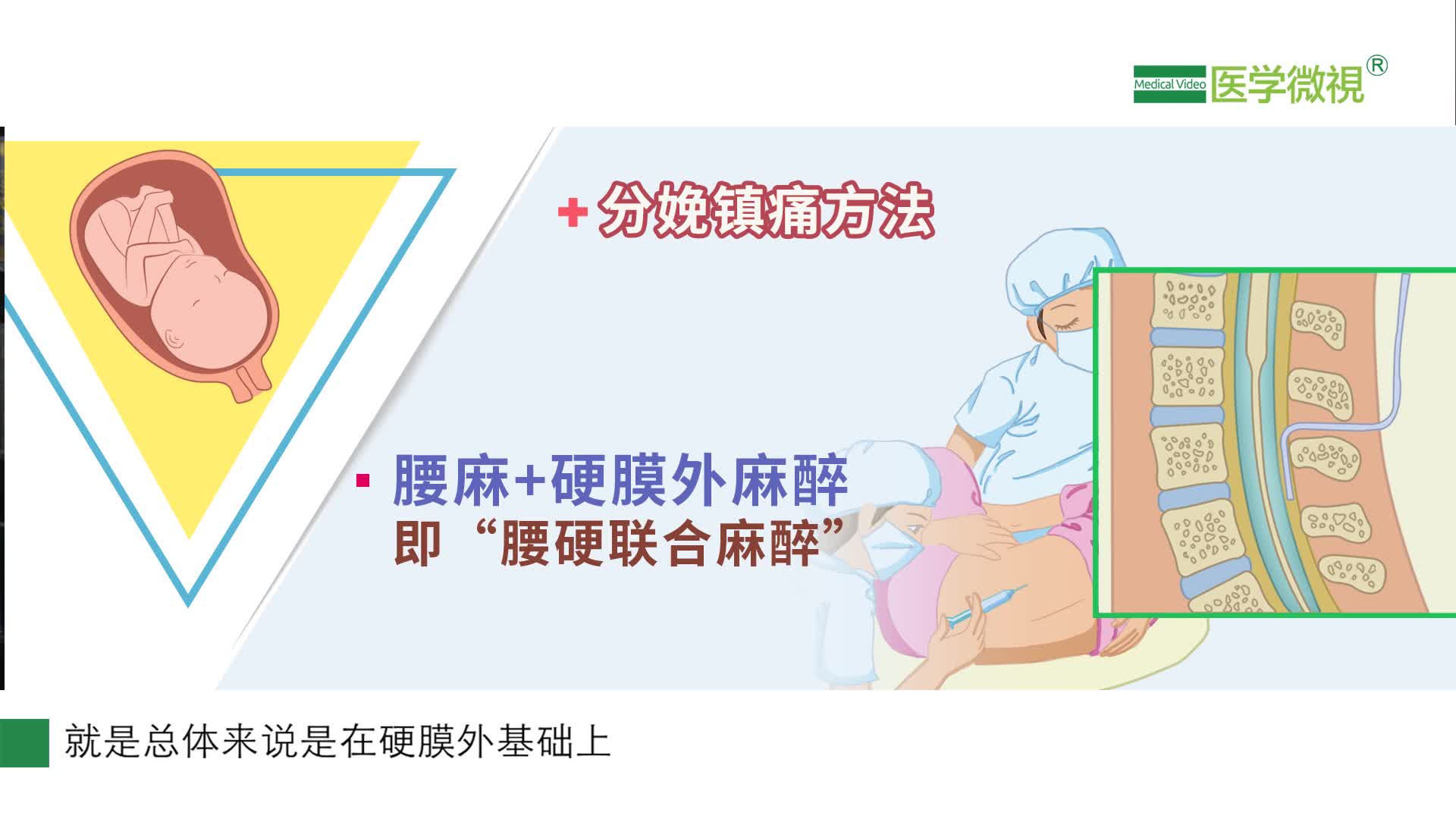 什么是腰硬联合麻醉分娩镇痛最常用的方法是哪种