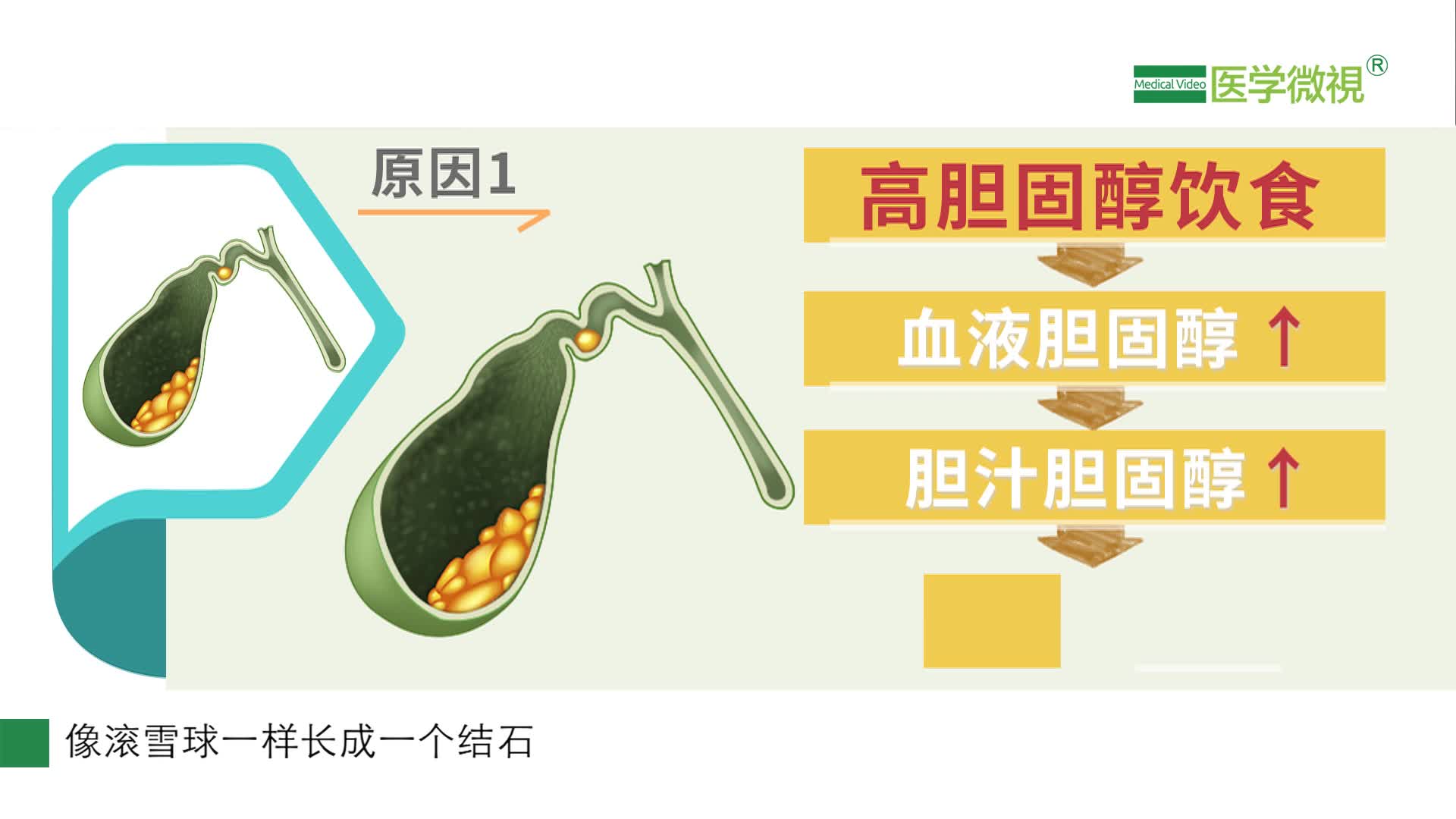 胆结石的形成与哪些因素有关?