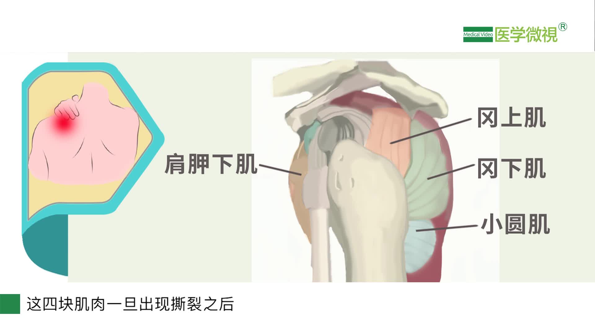 肩周炎和肩袖撕裂如何区分?