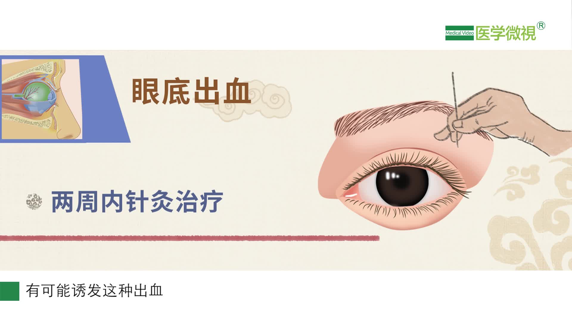 针灸可以治疗眼底出血吗?