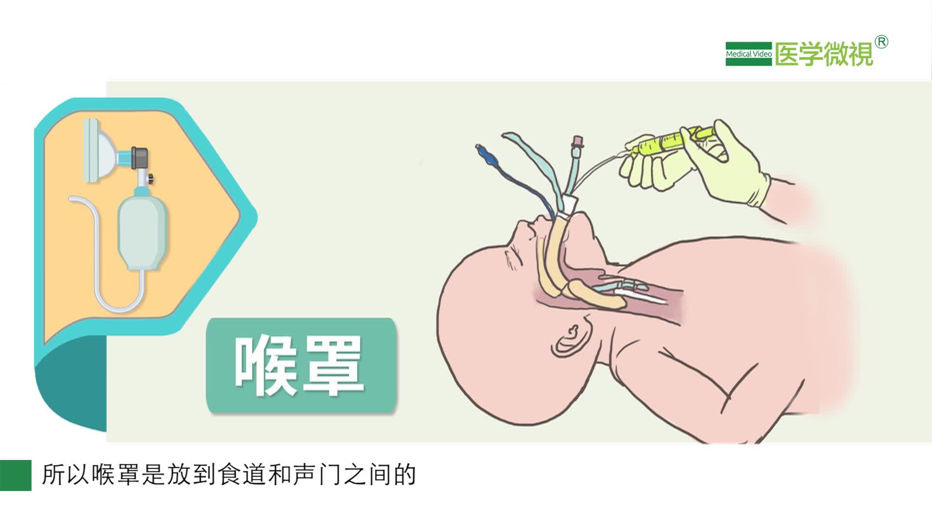 什么是喉罩在小儿麻醉过程中有什么作用